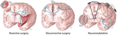 Outcome of emergency neurosurgery in patients with refractory and super-refractory status epilepticus: a systematic review and individual participant data meta-analysis